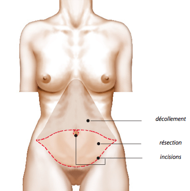 abdominoplastie chirurgie paroi abdominale