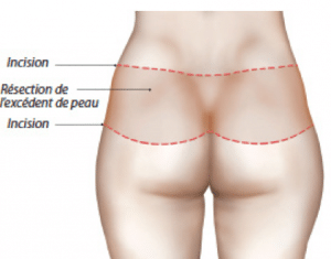 augmentation des fesses nicolas corbisier