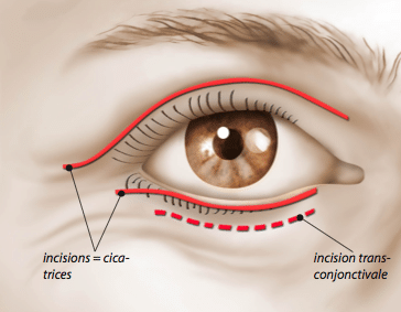 blepharoplastie chirurgie paupiere docteur corbisier