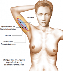 brachioplastie nicolas corbisier