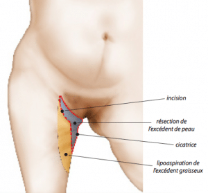 cuisslift docteur corbisier chirurgie esthetique