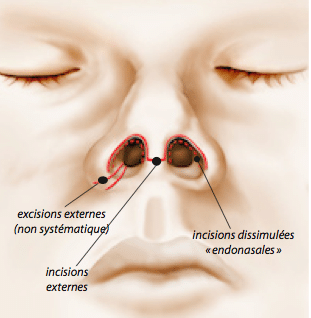 rhinoplastie docteur corbisier nord